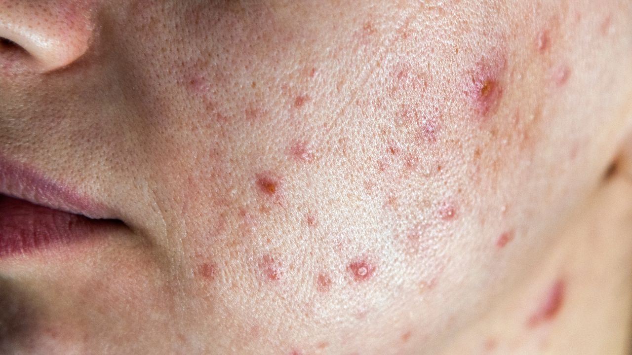 Acne Breakouts: The Complete Guide to Understanding, Treating, and Preventing Acne