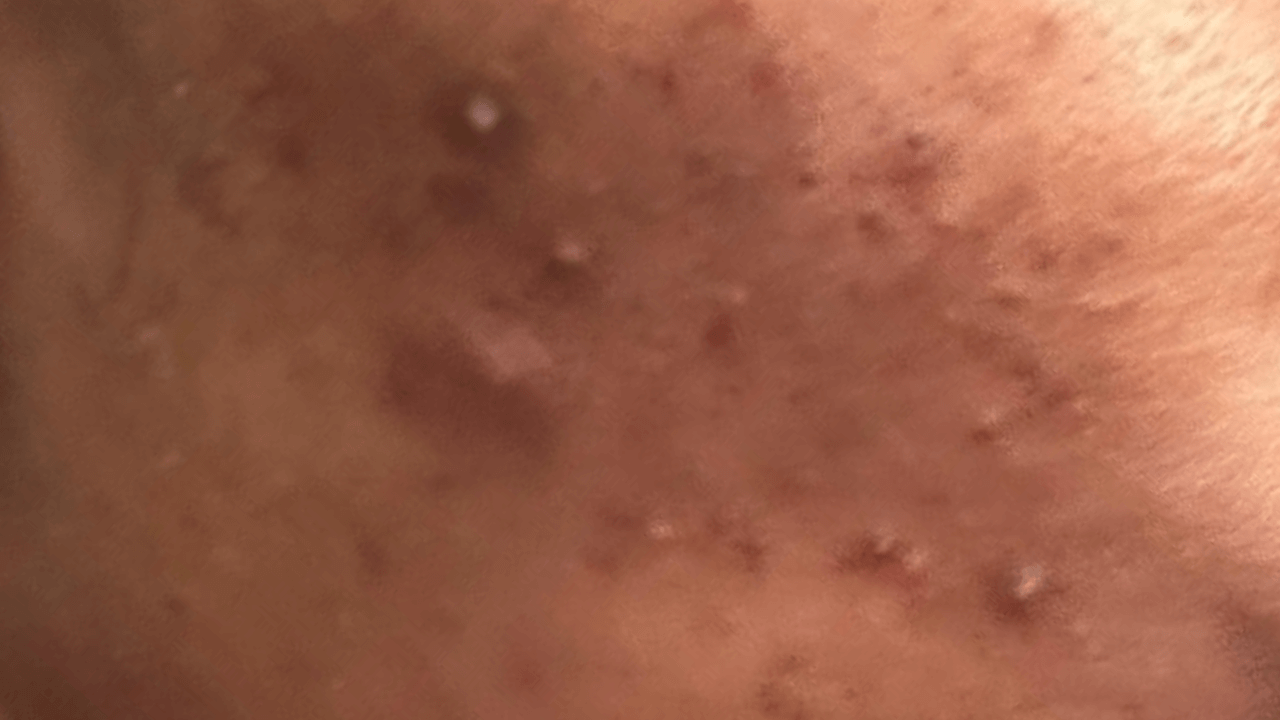 My Secret Weapon for Hyperpigmentation!