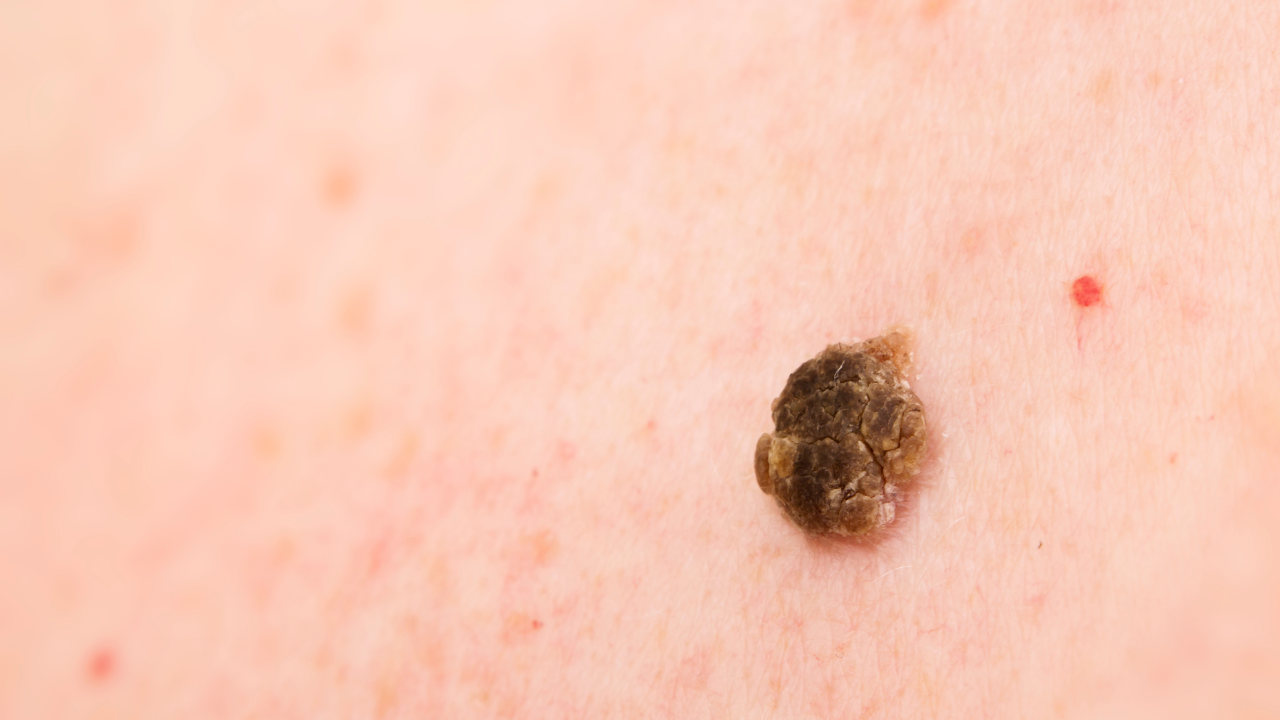 Seborrheic Keratosis: What You Need to Know About These Common Skin Growths