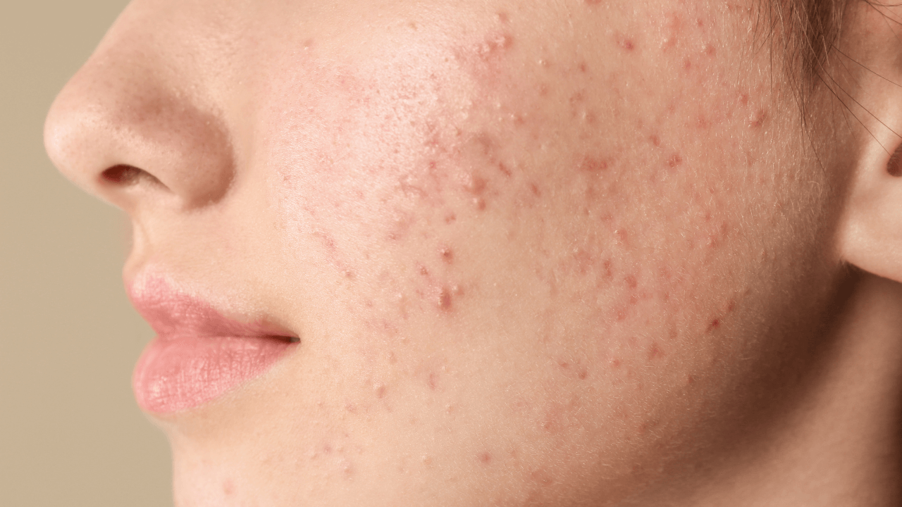 Acne: The Complete Guide to Understanding and Managing Skin's Most Common Condition