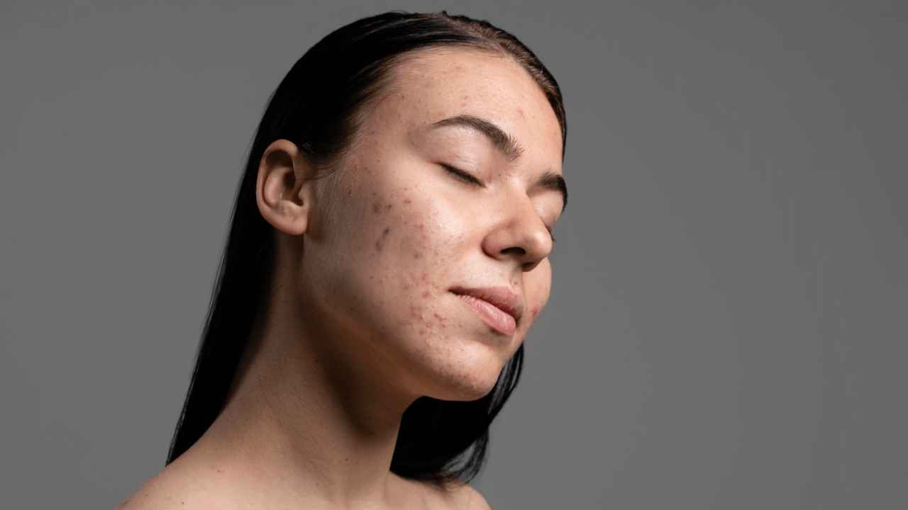 How to Do Spot Treatment for Breakouts: Your Complete Guide to Clear Skin