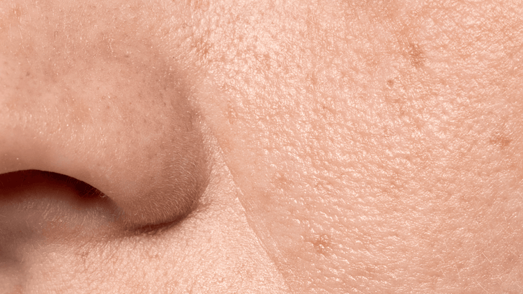 Bumpy Synym How to Reduce Bumpy Skin: Your Complete Guide to Smoother Texture ...