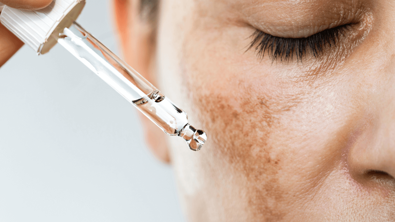 Hyperpigmentation: The Complete Guide to Understanding and Treating Uneven Skin Tone