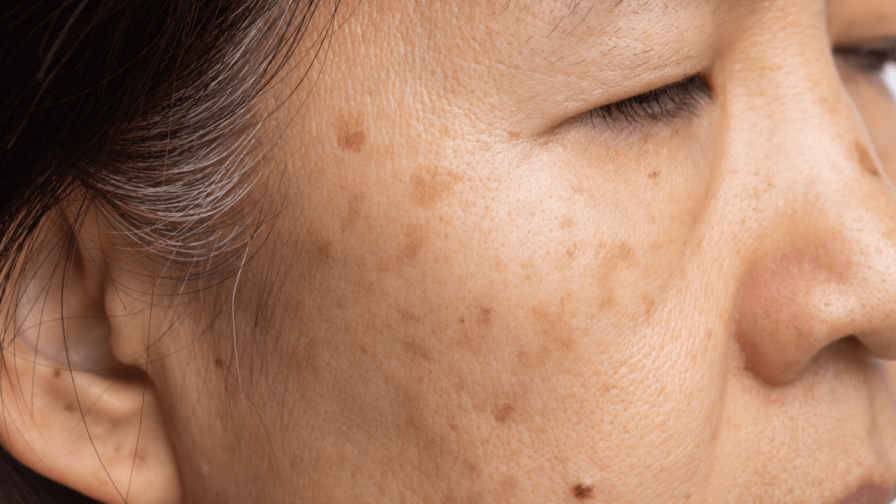 Melasma: The Complete Guide to Understanding and Managing the Mask of Pregnancy
