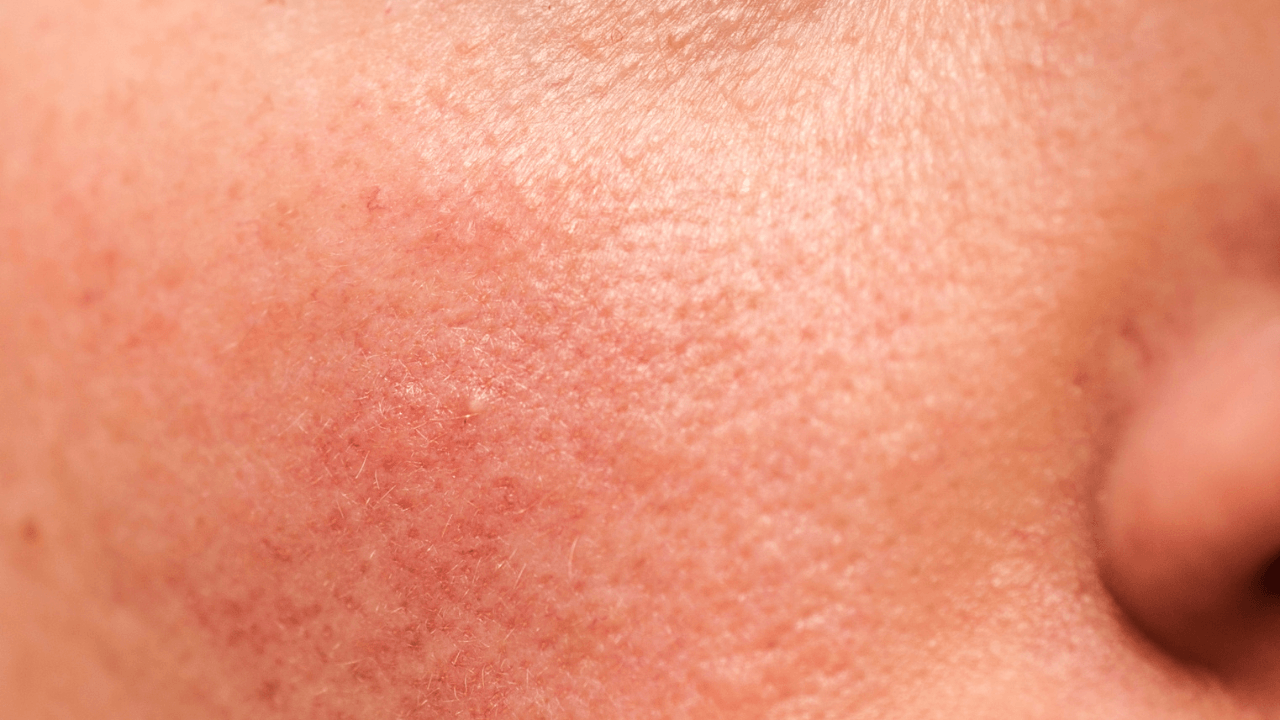 Papulopustular Rosacea (Subtype 2): Understanding This Common Inflammatory Skin Condition