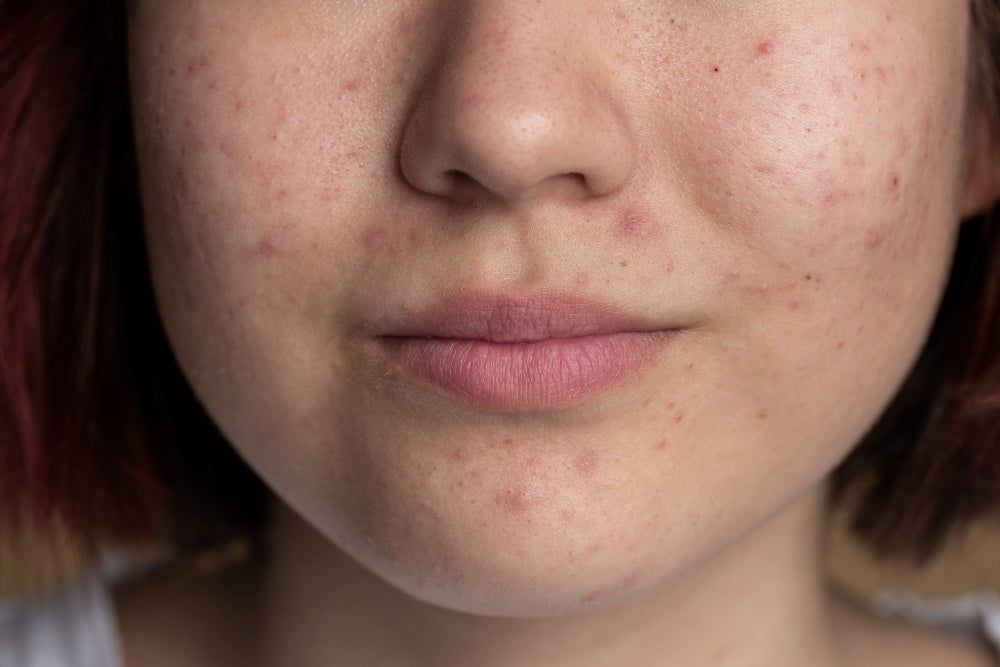 Clearing Post-Acne Marks: Your Complete Guide to Smoother, Even-Toned Skin