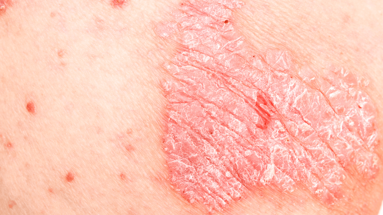 Understanding Psoriasis: Causes, Symptoms, and Treatment Approaches