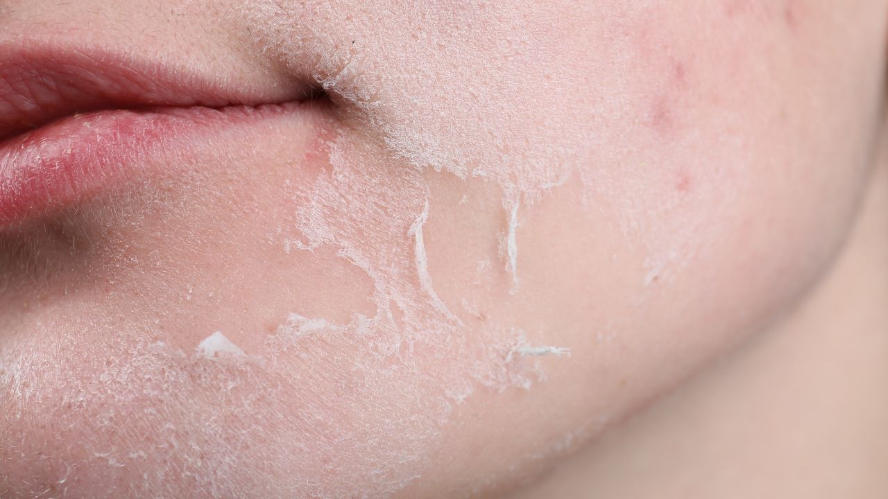 Skin Dryness vs. Dehydration: The Complete Guide to Understanding and Treating Both
